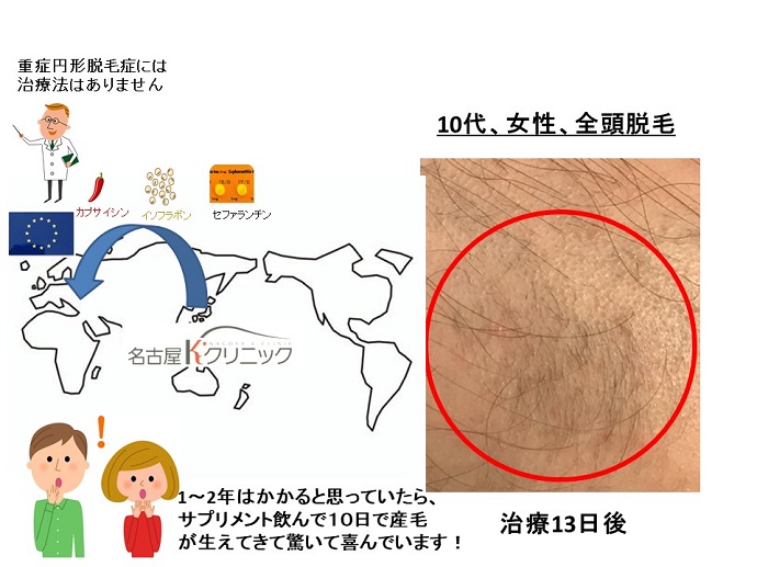 円形脱毛症　病院